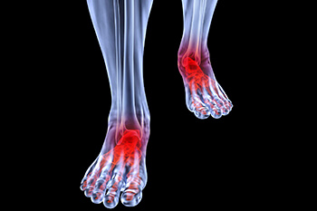 arthritic foot and ankle care treatment in the West Hollywood, CA 90048 area
