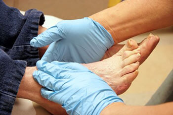diabetic foot treatment in the West Hollywood, Los Angeles, CA 90048 area