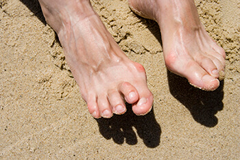 hammertoes treatment in the West Hollywood, CA 90048 area