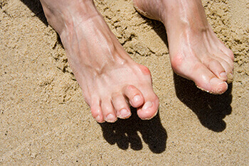 hammertoes treatment in the West Hollywood, CA 90048 area