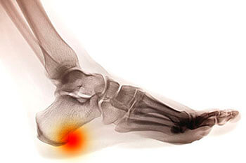 Heel spurs treatment in the West Hollywood, CA 90048 area