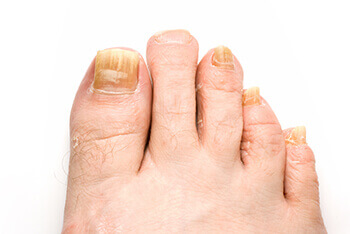 Toenail fungus restoration in West Hollywood, CA 90048